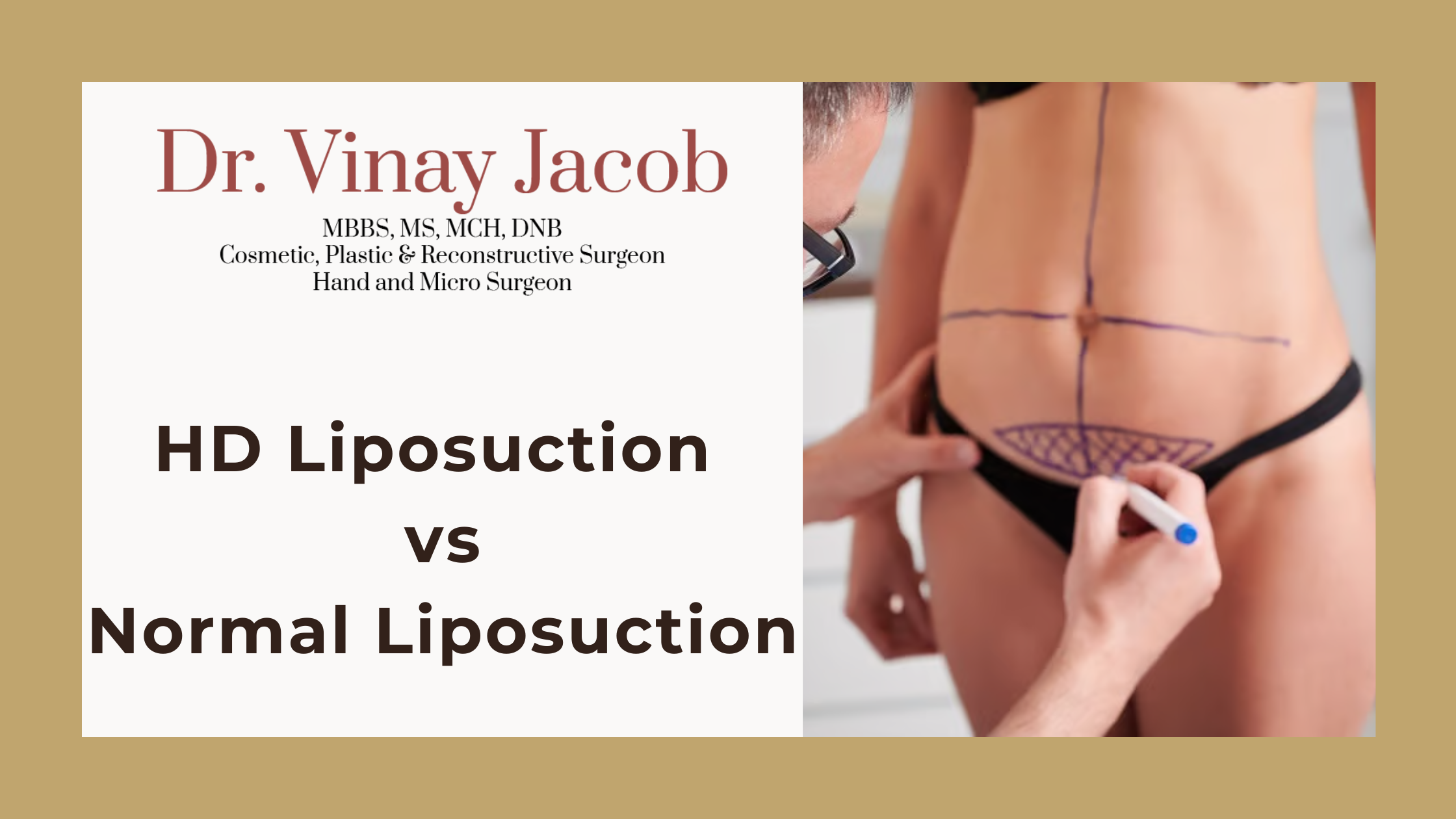 HD Liposuction vs Normal Liposuction: Which Is Right for You?